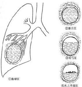 包虫最新研究，了解、预防与治疗进展概览