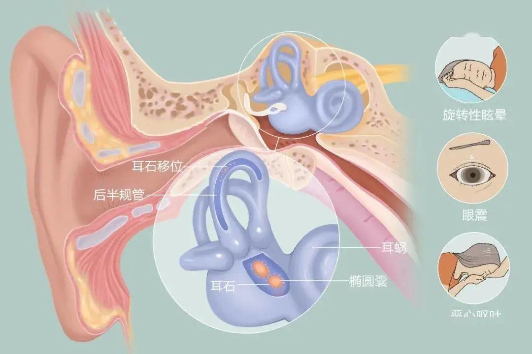 耳石症最新研究进展与治疗方法综述