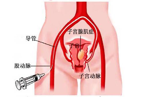 子宫腺肌瘤最新最佳治疗方法探讨